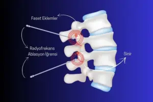 radyofrekans tedavisi nasıl yapılır