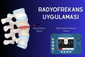 radyofrekans tedavisi yan etkileri